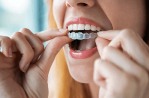 Woman putting in her clear invisalign aligners. Picture for the blog "Is Invisalign Worth It"